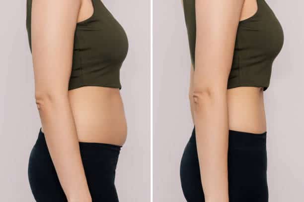 Superficial Liposuction Phoenix Liposuction