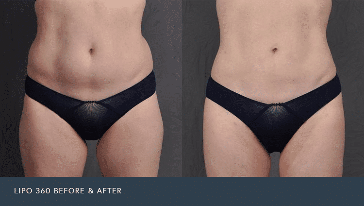 Back Fat Removal - Male & Female - LIPO 360 Before And After