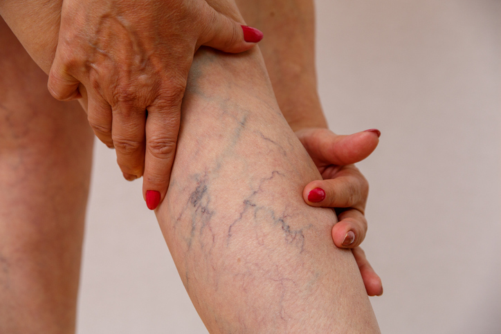 Your Path to Vein Wellness: The First Steps in Varicose Vein Treatment