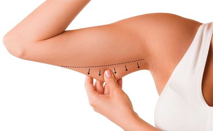 Visual Impact: Before and After Comparisons of Arm Liposuction Transformations