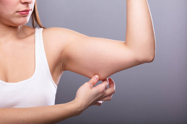 Aging Gracefully: Arm Liposuction for Individuals Over 50