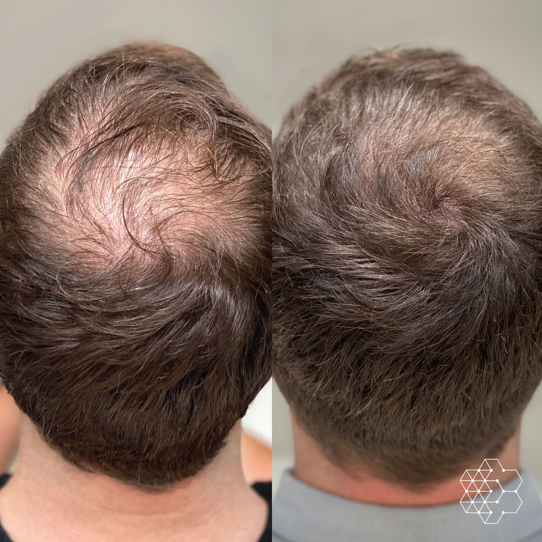 Scalp Reduction for Hair Loss: A Permanent Solution