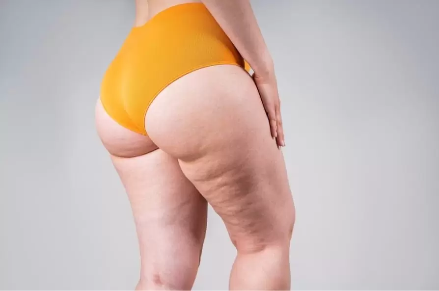 Lipedema Causes: Genetics and Lifestyle Impact