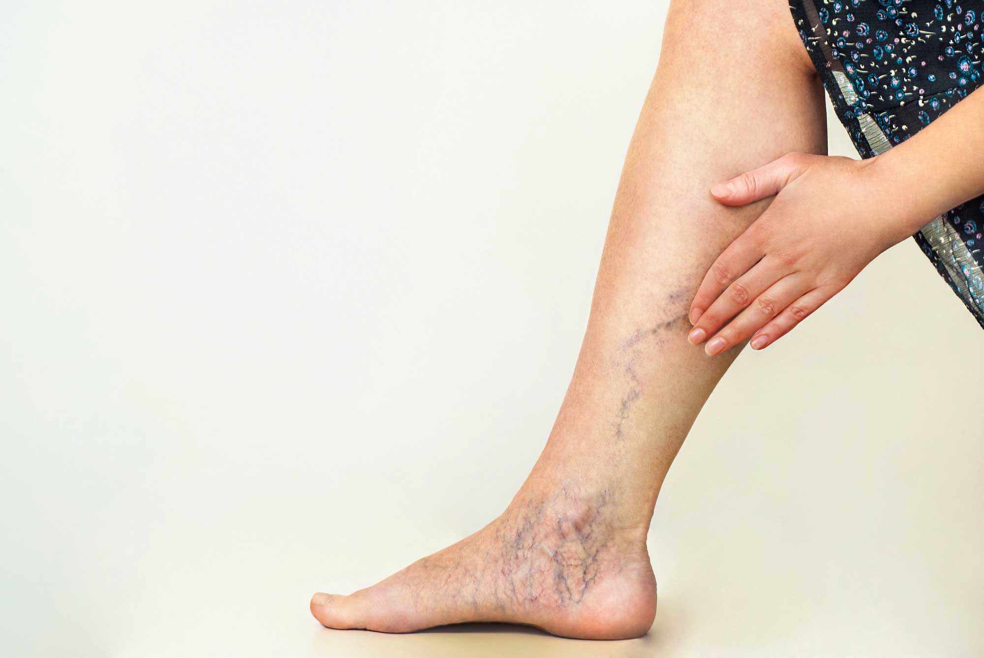 Varicose Veins: Symptoms, When to See a Doctor, and Prevention Strategies