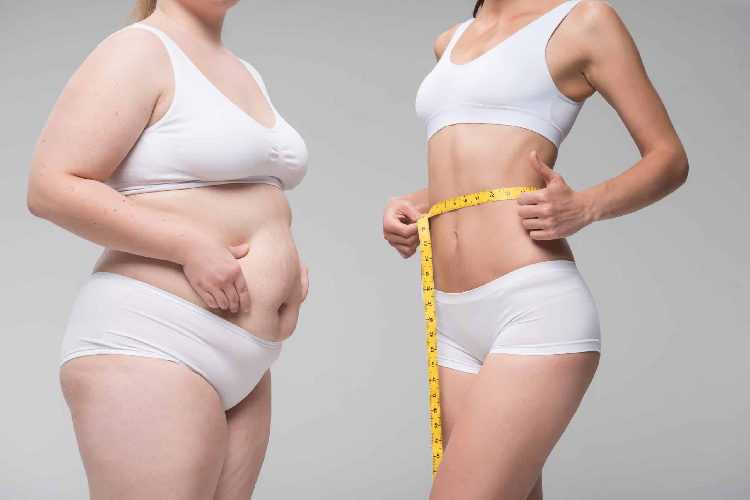 Awake Liposuction for Plus Size Patients | Essential Tips and Guidelines