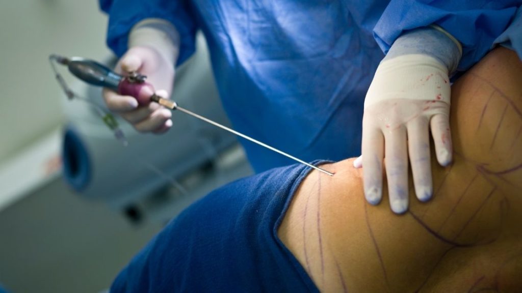 ¿Dónde va la grasa extraída durante una liposucción?